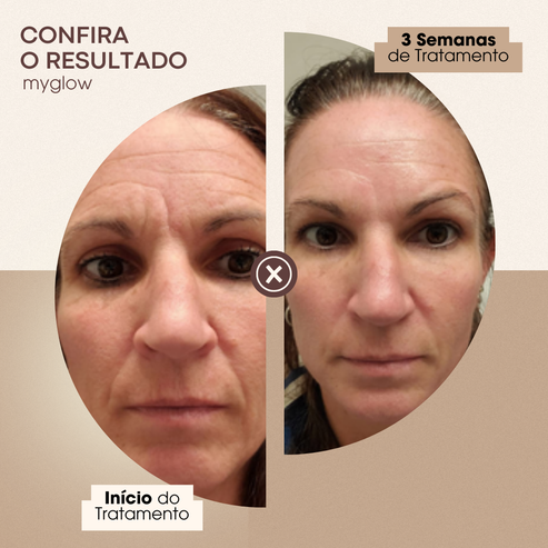 My Glow Sérum Anti Rugas | 30 cápsulas