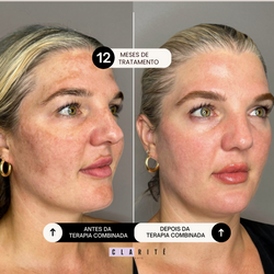 Clarité  Terapia Combinada Anti Melasma 1 mês | 30 cápsulas
