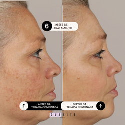 Clarité  Terapia Combinada Anti Melasma 1 mês | 30 cápsulas
