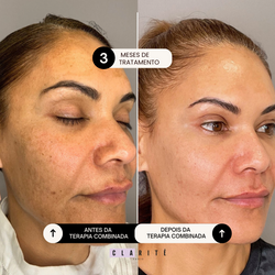 Clarité  Terapia Combinada Anti Melasma 1 mês | 30 cápsulas